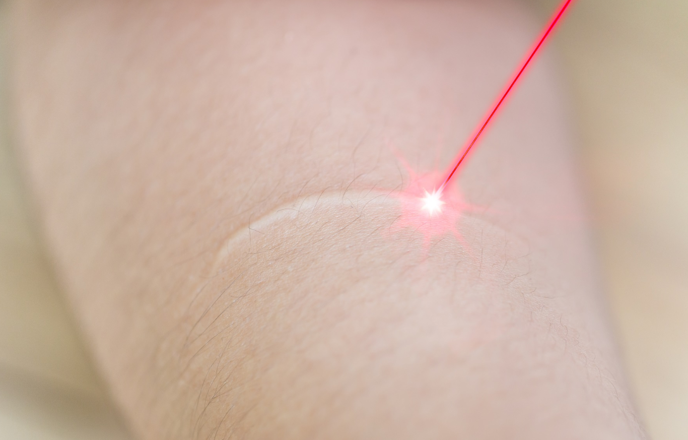Laser Scar Removal for Safe and Effective Skin Healing