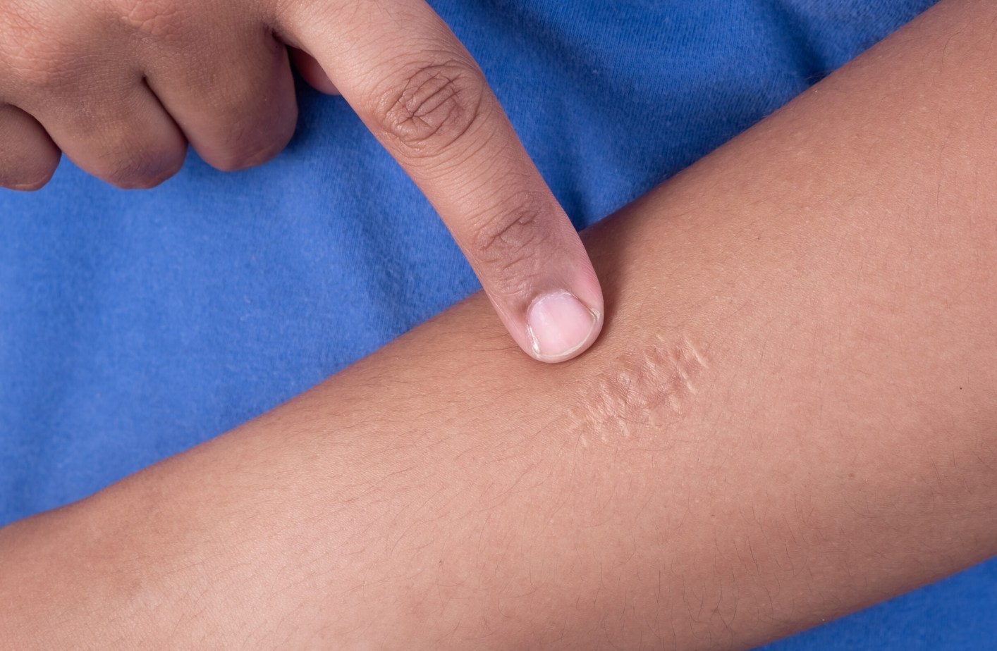 Laser scar removal kyiv